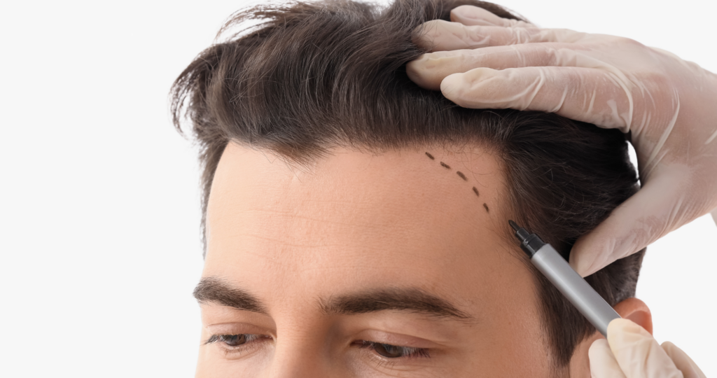 Tout savoir sur la greffe capillaire : techniques FUE et FUT, prix, résultats, et conseils après l’intervention. Une solution durable contre la calvitie.